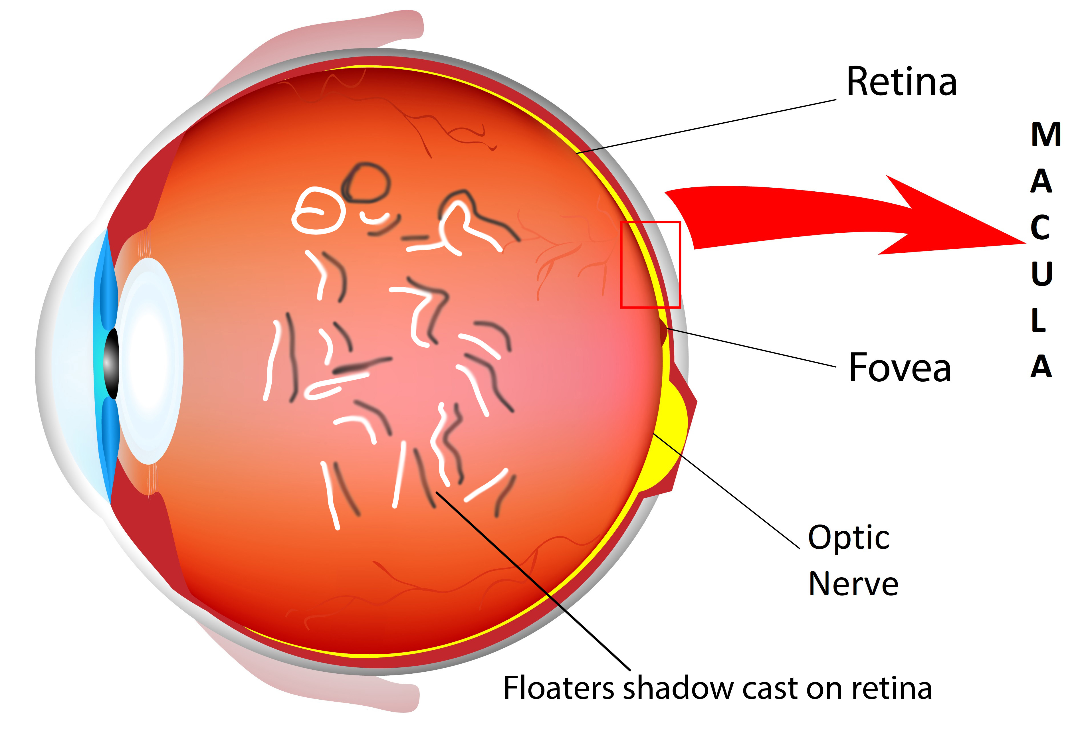 Floaters shadow viswanathan shrewsbury retinal surgeon